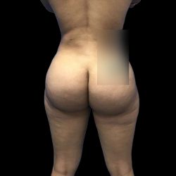 Brazilian Butt Lift Before & After Patient #228