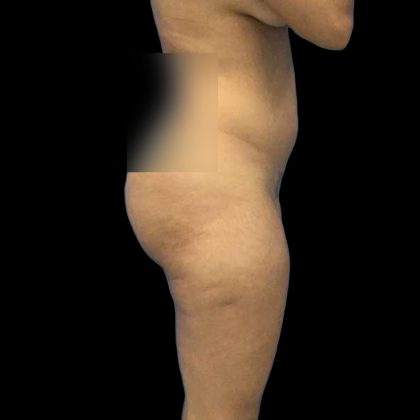Brazilian Butt Lift Before & After Patient #228