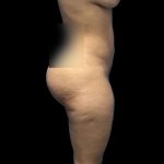 Brazilian Butt Lift Before & After Patient #228