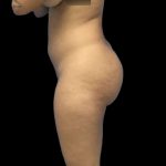 Brazilian Butt Lift Before & After Patient #228
