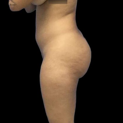 Brazilian Butt Lift Before & After Patient #228