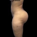 Brazilian Butt Lift Before & After Patient #228