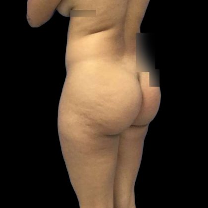 Brazilian Butt Lift Before & After Patient #228
