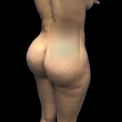 Brazilian Butt Lift Before & After Patient #228