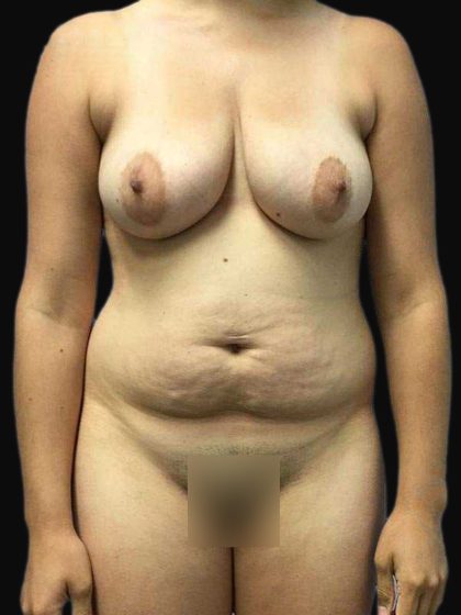 Brazilian Butt Lift Before & After Patient #183