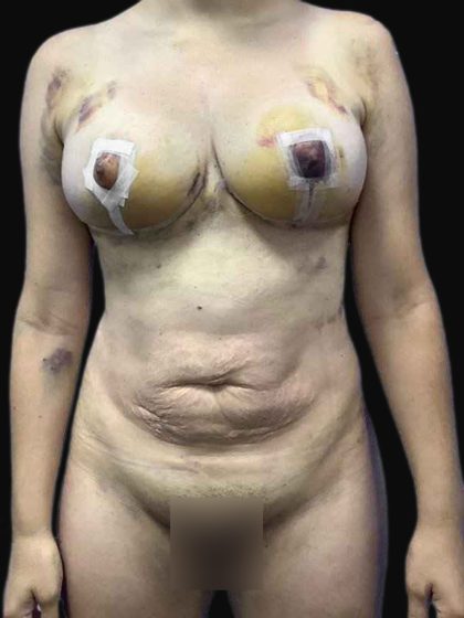 Brazilian Butt Lift Before & After Patient #183