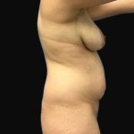 Brazilian Butt Lift Before & After Patient #183