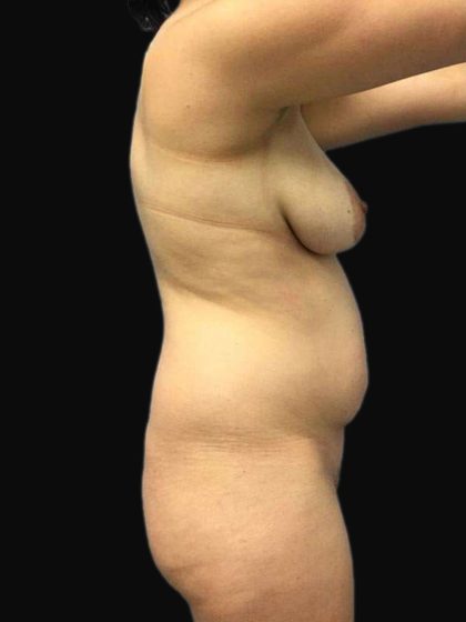 Brazilian Butt Lift Before & After Patient #183