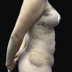 Brazilian Butt Lift Before & After Patient #183