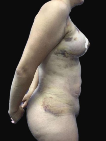 Brazilian Butt Lift Before & After Patient #183