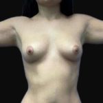 Brazilian Butt Lift Before & After Patient #89