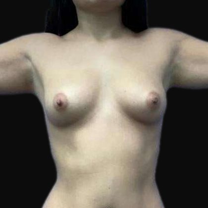 Brazilian Butt Lift Before & After Patient #89