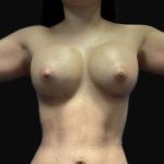 Brazilian Butt Lift Before & After Patient #89