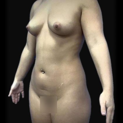 Brazilian Butt Lift Before & After Patient #89