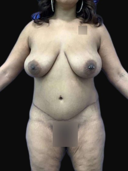 Breast Lift Before & After Patient #105
