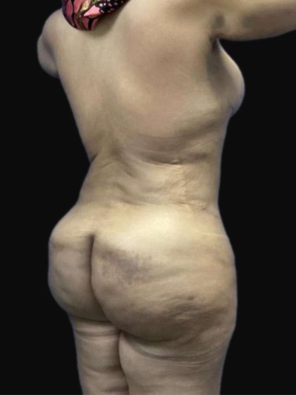 Breast Lift Before & After Patient #105