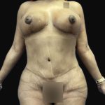 Breast Lift Before & After Patient #105