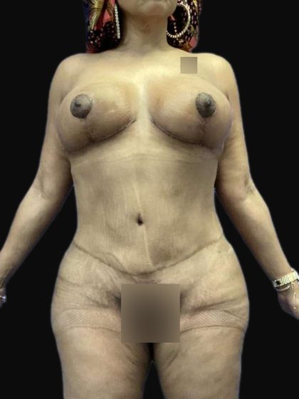 Breast Lift Before & After Patient #105