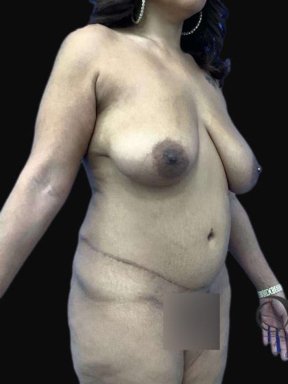 Breast Lift Before & After Patient #105