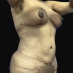 Breast Lift Before & After Patient #105