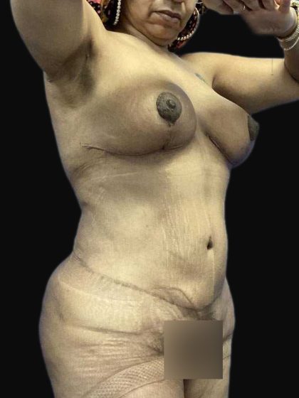Breast Lift Before & After Patient #105