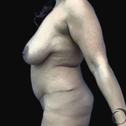 Breast Lift Before & After Patient #105