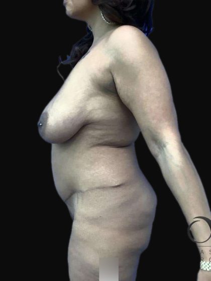 Breast Lift Before & After Patient #105
