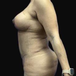 Breast Lift Before & After Patient #105