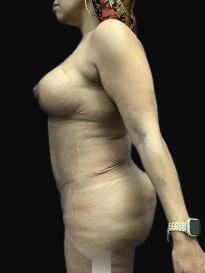 Breast Lift Before & After Patient #105