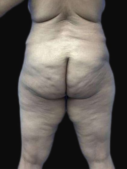Breast Lift Before & After Patient #105