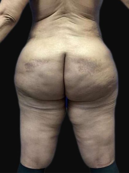 Breast Lift Before & After Patient #105
