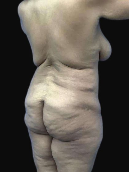 Breast Lift Before & After Patient #105