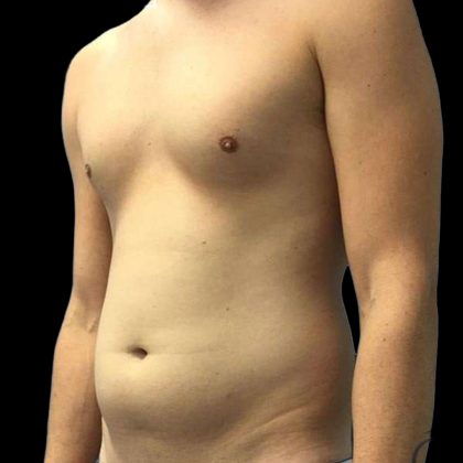 Brazilian Butt Lift Before & After Patient #154