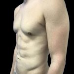 Brazilian Butt Lift Before & After Patient #154