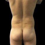 Brazilian Butt Lift Before & After Patient #154