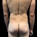 Brazilian Butt Lift Before & After Patient #154