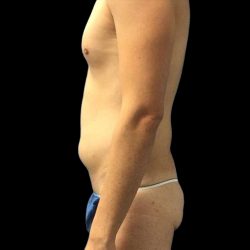 Brazilian Butt Lift Before & After Patient #154