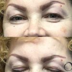 Blepharoplasty Before & After Patient #67