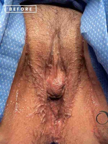 Labiaplasty Before & After Patient #231