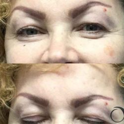 Blepharoplasty Before & After Patient #67
