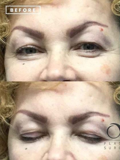 Blepharoplasty Before & After Patient #67