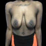 Breast Lift Before & After Patient #119