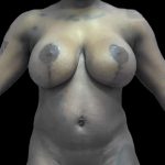 Breast Lift Before & After Patient #119