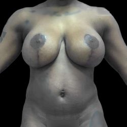 Breast Lift Before & After Patient #119