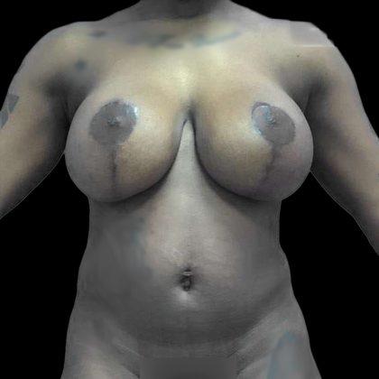 Breast Lift Before & After Patient #119