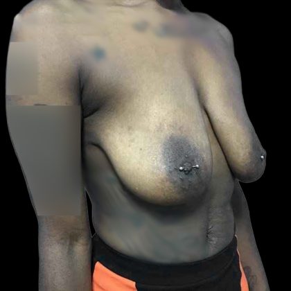 Breast Lift Before & After Patient #119