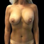 Breast Lift Before & After Patient #140