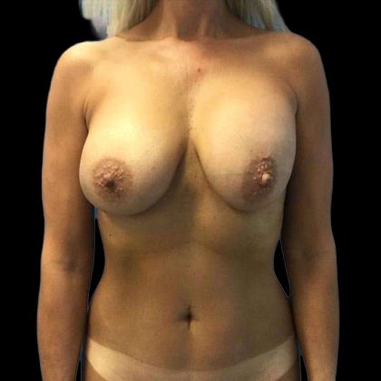 Breast Lift Before & After Patient #140