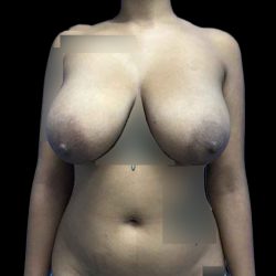Breast Lift Before & After Patient #147