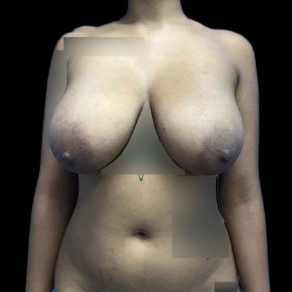 Breast Lift Before & After Patient #147